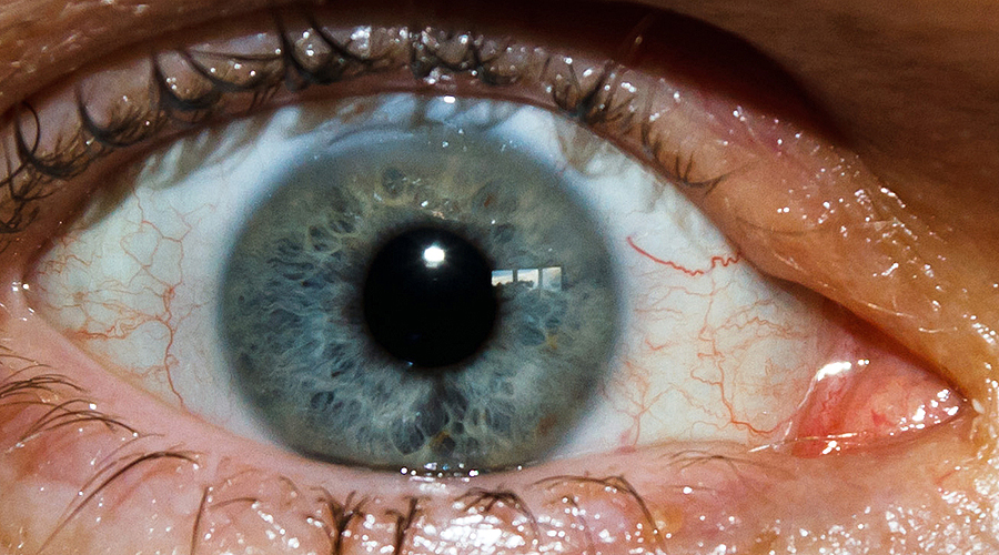 What causes eye floaters after cataract surgery?