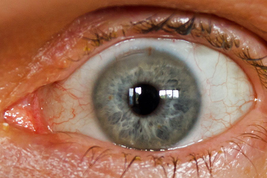 How do you wear contact lenses after having cataract surgery?