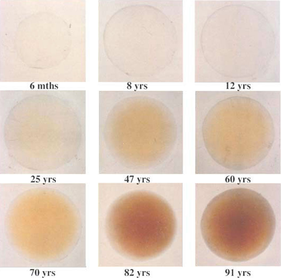 yellowing of lens with age