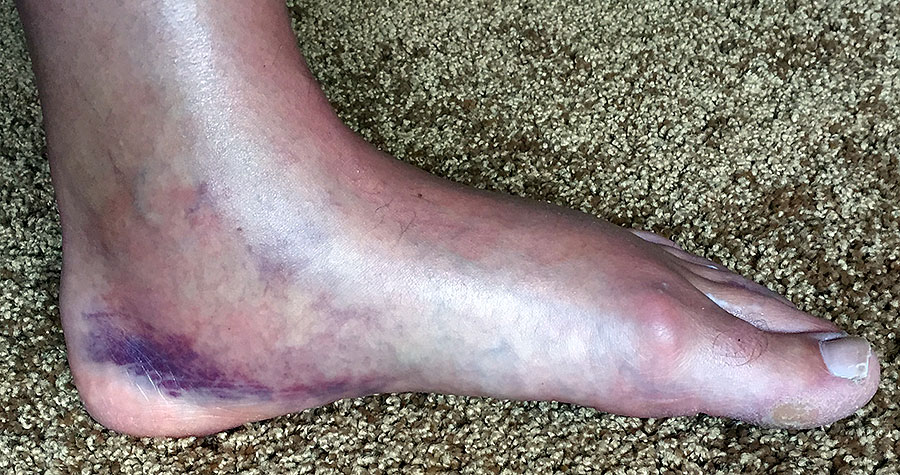 Fractured Fibula swollen foot
