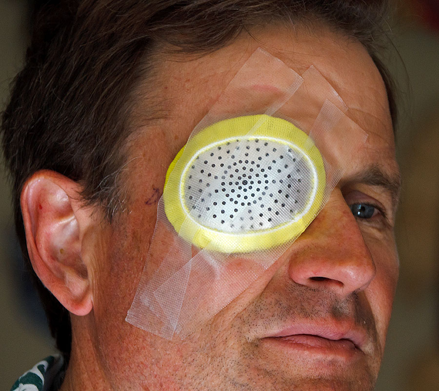 cataract surgery crystalens right eye 2