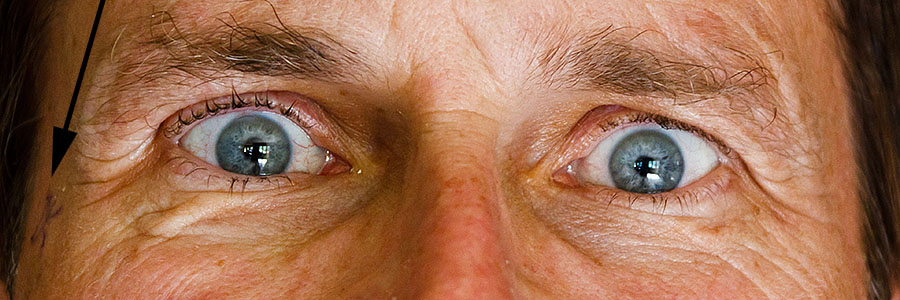 after cataract surgery crystalens both eyes