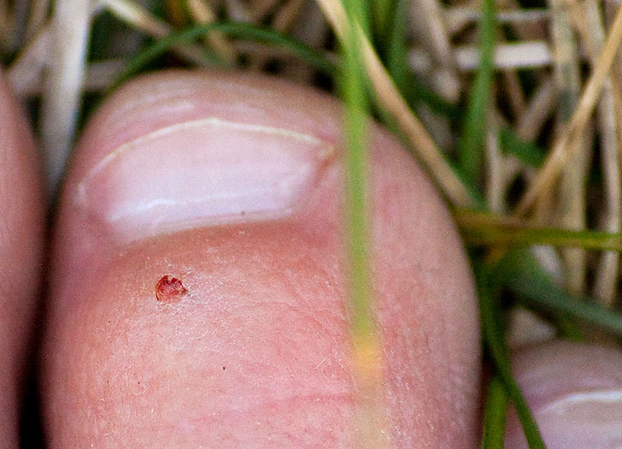 bee stinger wound