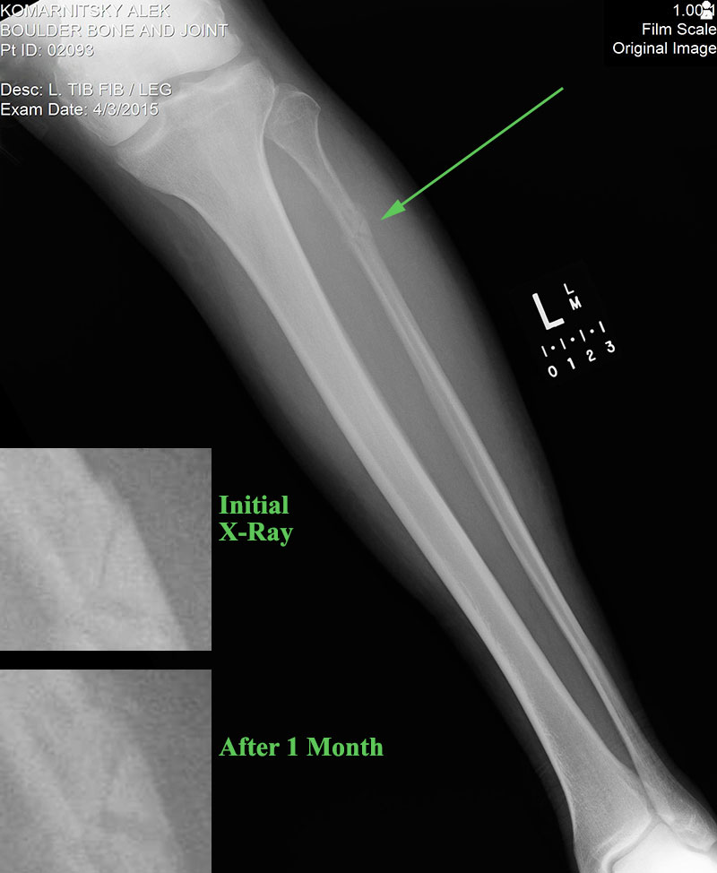 fractured fibula after one month