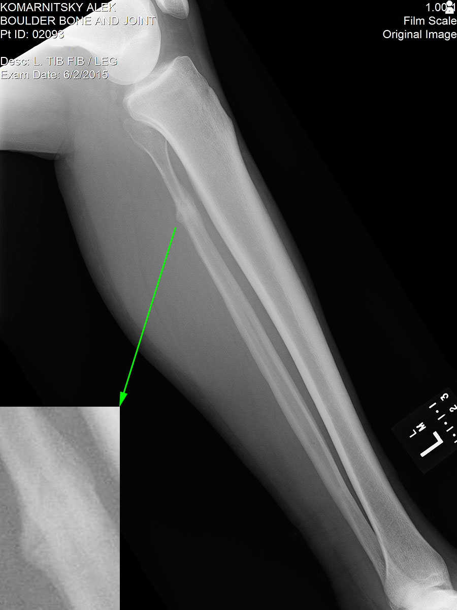 fractured fibula after three months months