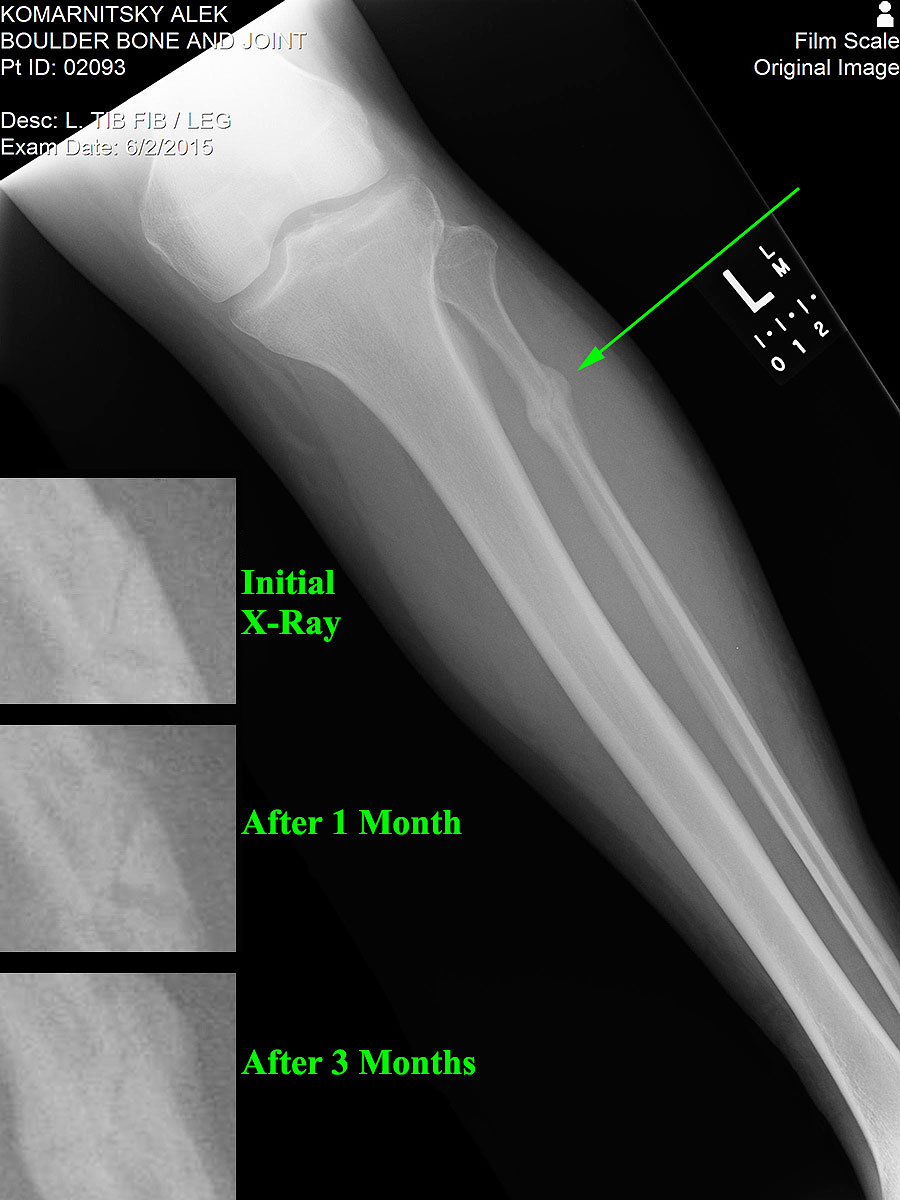 fractured fibula after three months months