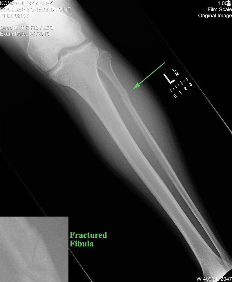 X-Ray of Fractured Fibula while skiing Upper Enchantment Forest at Copper Mountain